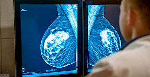 深度学习人工智能更好地预测乳腺癌风险