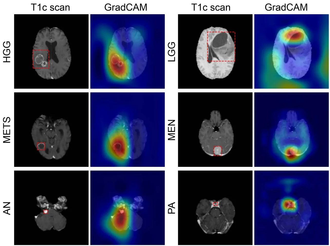 深度学习模型通过单次 MRI 扫描对脑肿瘤进行分类