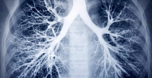 美国肺癌和黑色素瘤死亡人数迅速下降