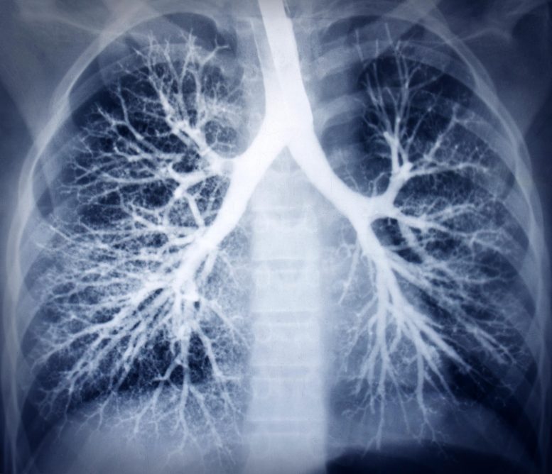 健康肺扫描