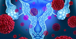 超重几乎使女性患子宫内膜癌的风险增加一倍