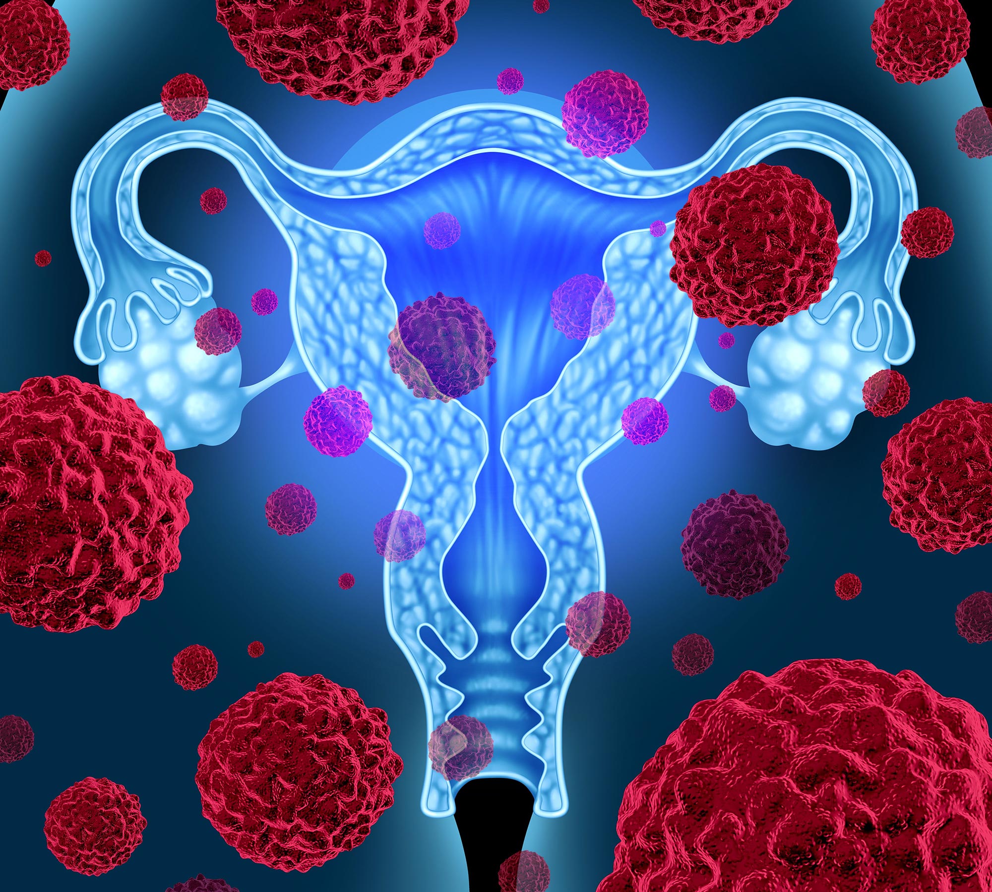 子宫内膜癌治疗概念
